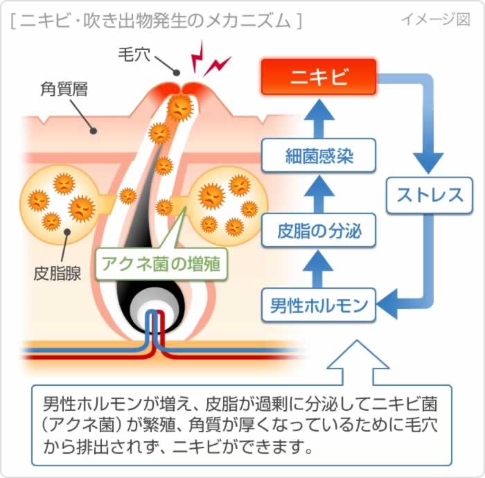 ニキビのメカニズム