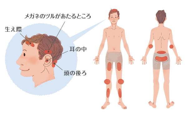 乾癬の好発部位