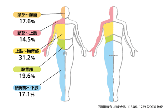 帯状疱疹の部位別発症率（顔、足、おしり、腕、首）
