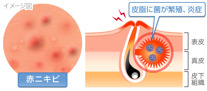 赤ニキビ